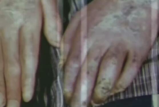 日本核辐射下的变异人