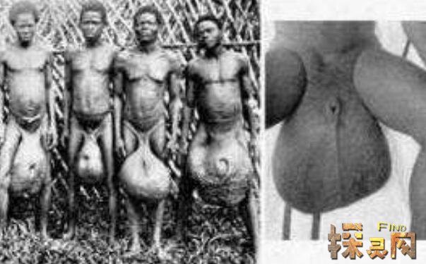世界上睾丸最大的民族 非洲巨阴族睾丸大如篮球 象皮病所致 探灵网