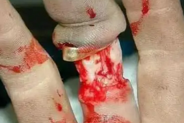 戴戒指打保龄球不安全手上的肉可能刮掉同时损坏戒指